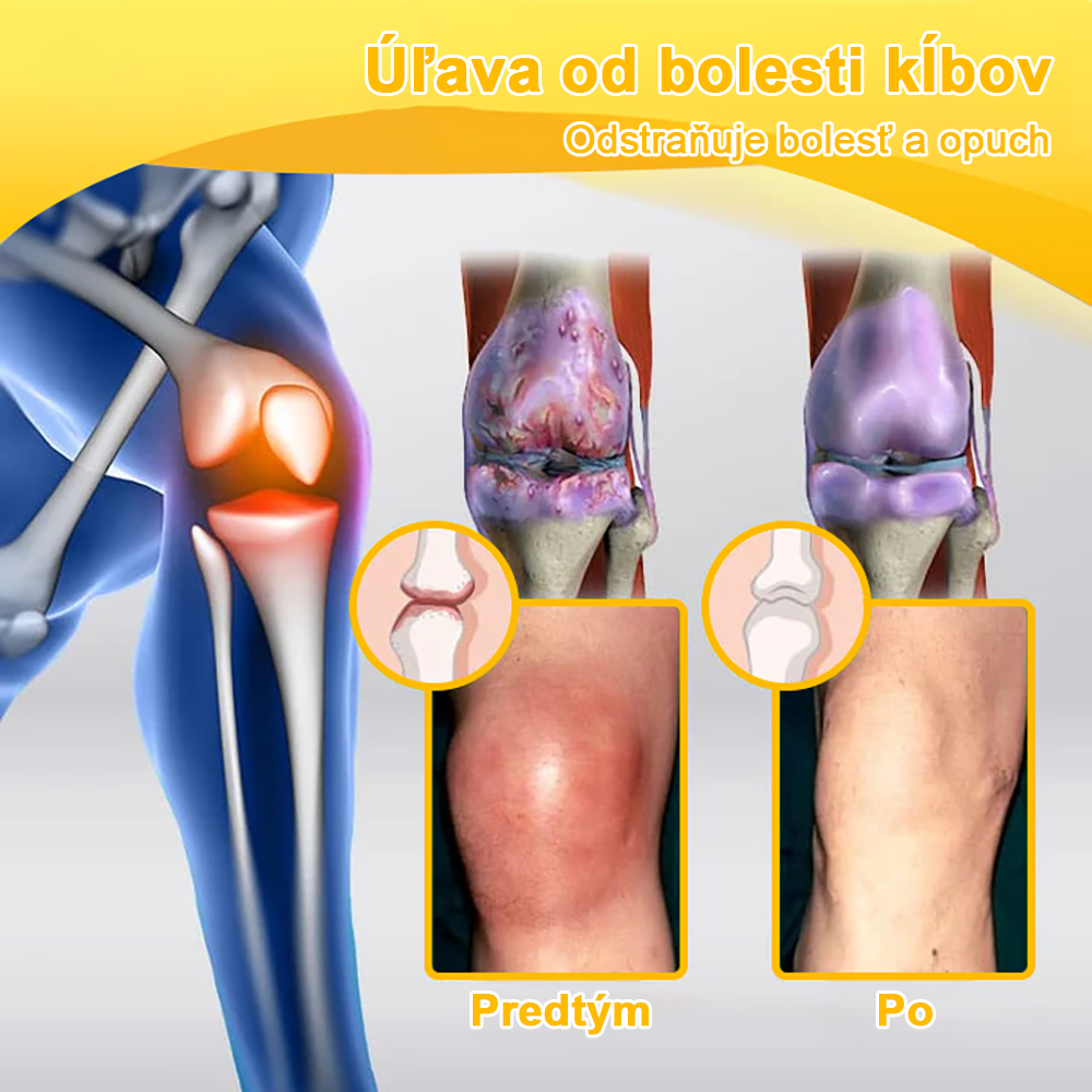 𝐀𝐫𝐭𝐡𝐫𝐨𝐅𝐫𝐞𝐞™  Včelí jed proti bolesti kĺbov a regeneračný krém🐝 (odporúčaný najmä pre starších ľudí a odporúčaný Ministerstvom zdravotníctva Slovenskej republiky - MZSR) 🍀